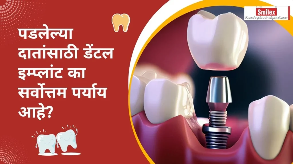 पडलेल्या दातांसाठी डेंटल इम्प्लांट(Dental Implant) का सर्वोत्तम पर्याय आहे? smilex blog 1 (3)