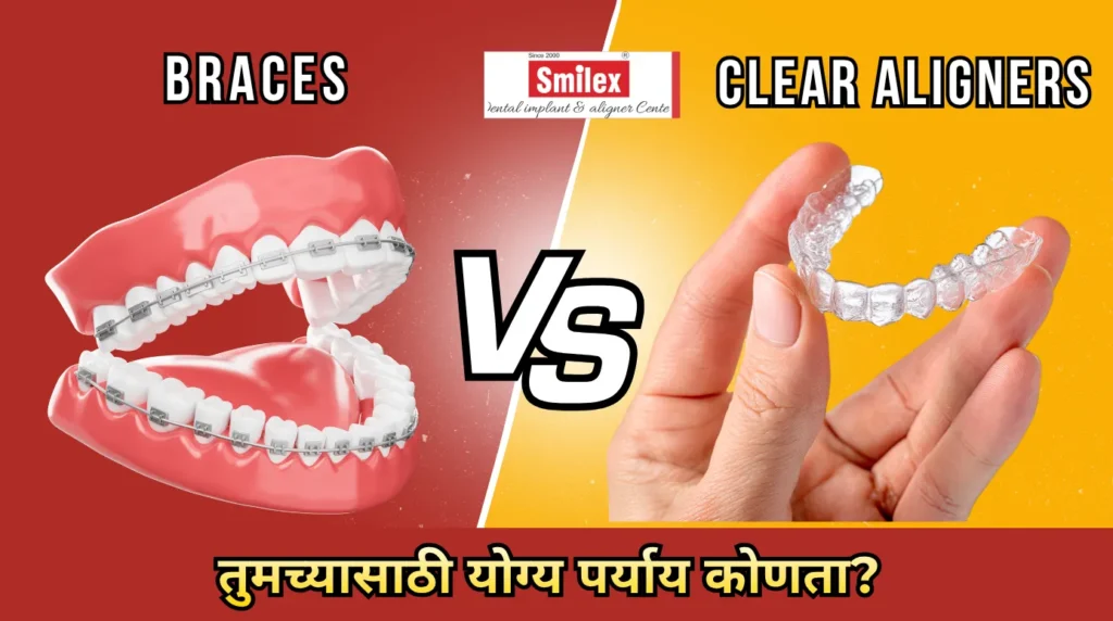 ब्रेसेस की अलायनर्स? तुमच्यासाठी योग्य पर्याय कोणता? smilex blog 1 (1)