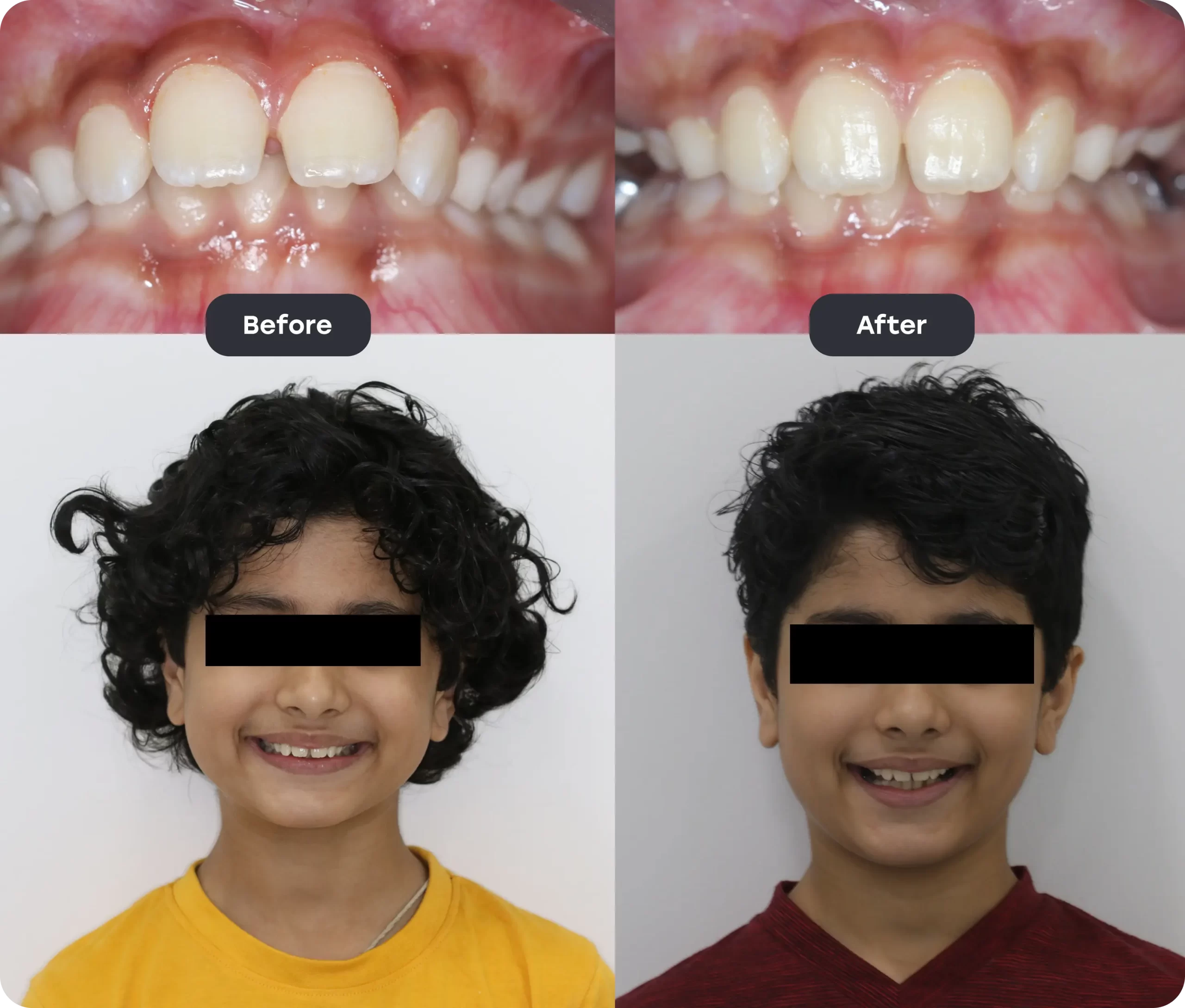 Invisalign Aligner before after new2 scaled