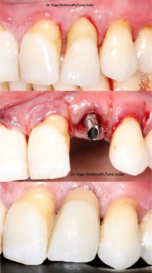 Same Day Dental Implants bf1 (1)
