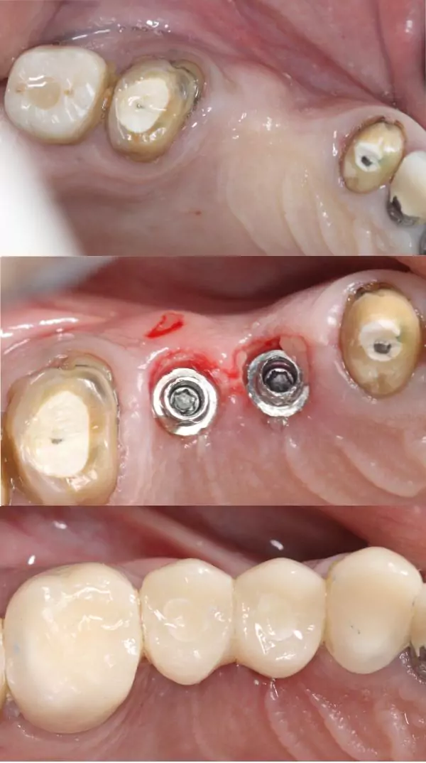 Same Day Dental Implants bf2