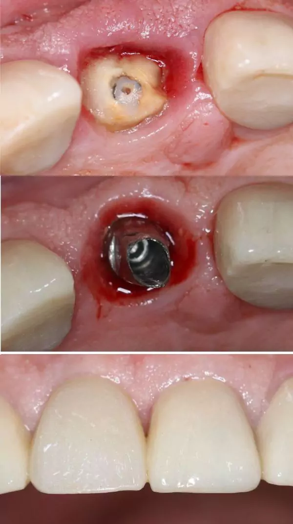 Same Day Dental Implants bf3 (1)