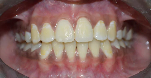 case4 after