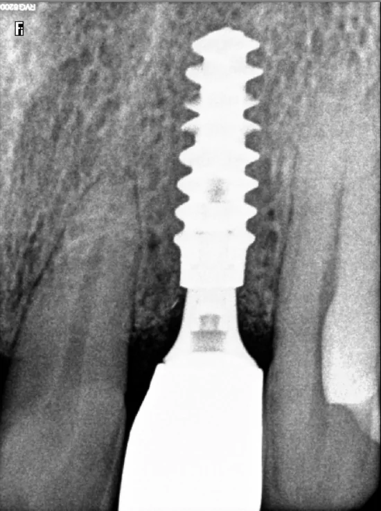 dental implant 1