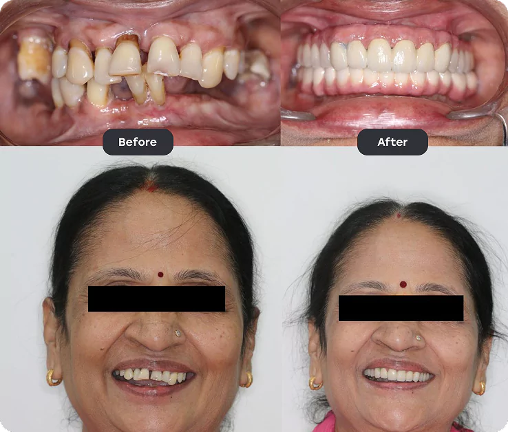 fullmputh before after 1