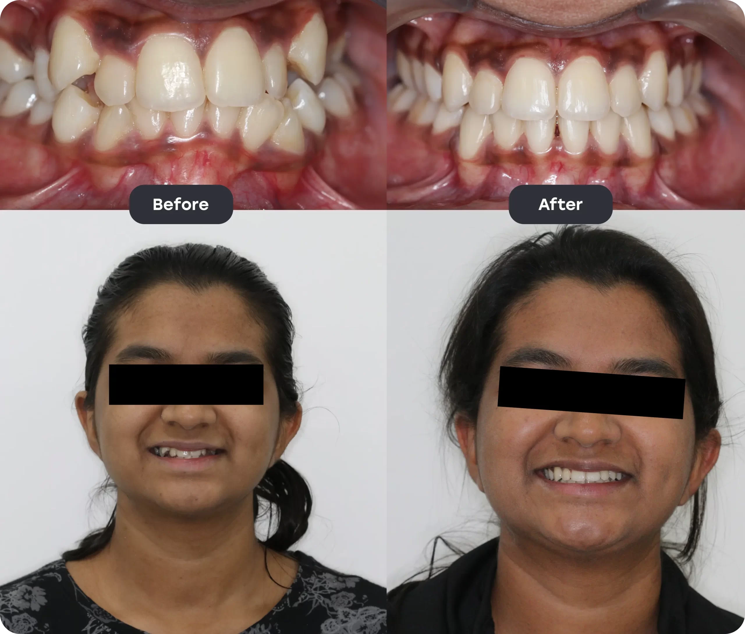 Invisalign Aligner invisalign bef aft 1 scaled