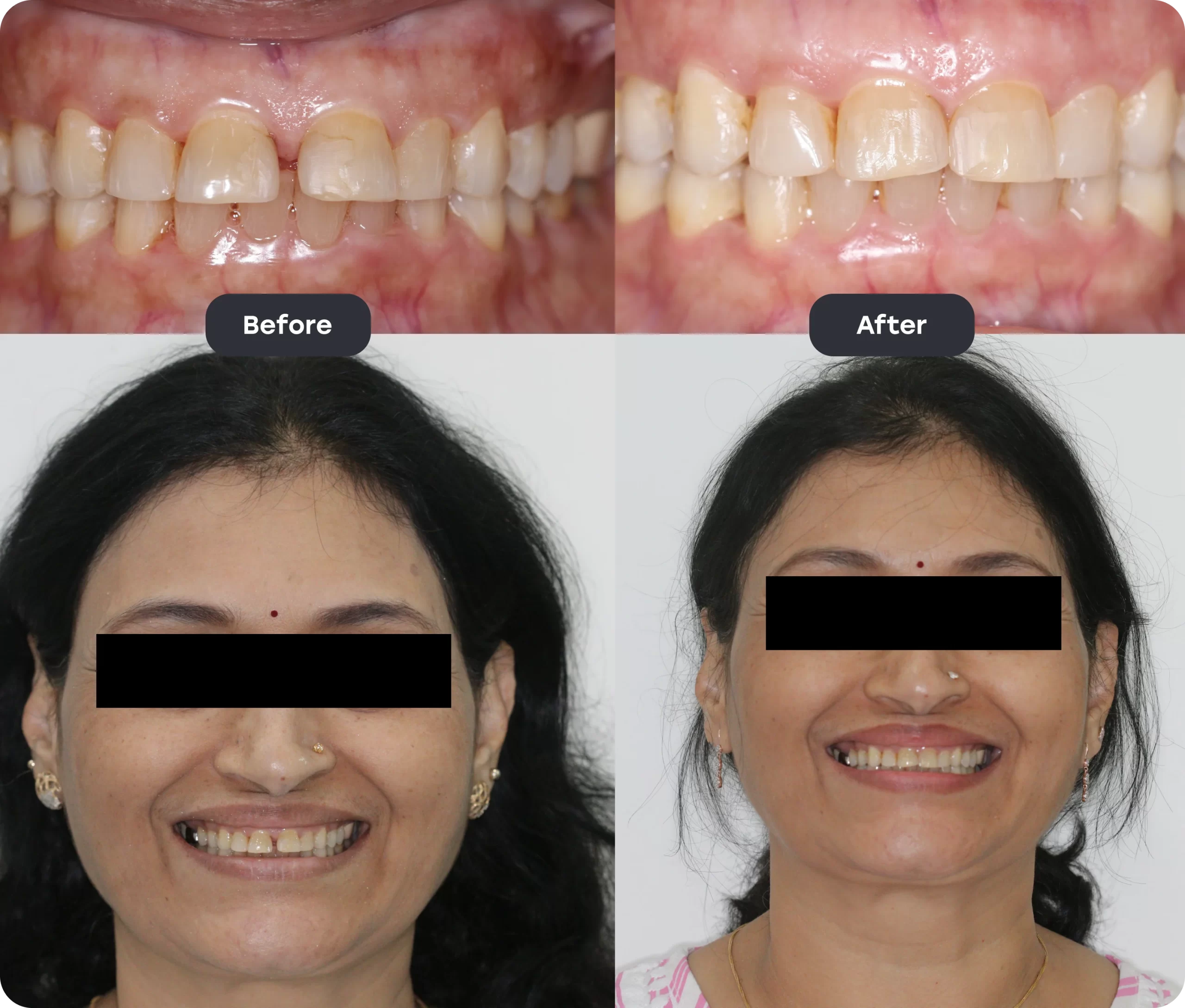 Invisalign Aligner invisalign bef aft 10 scaled