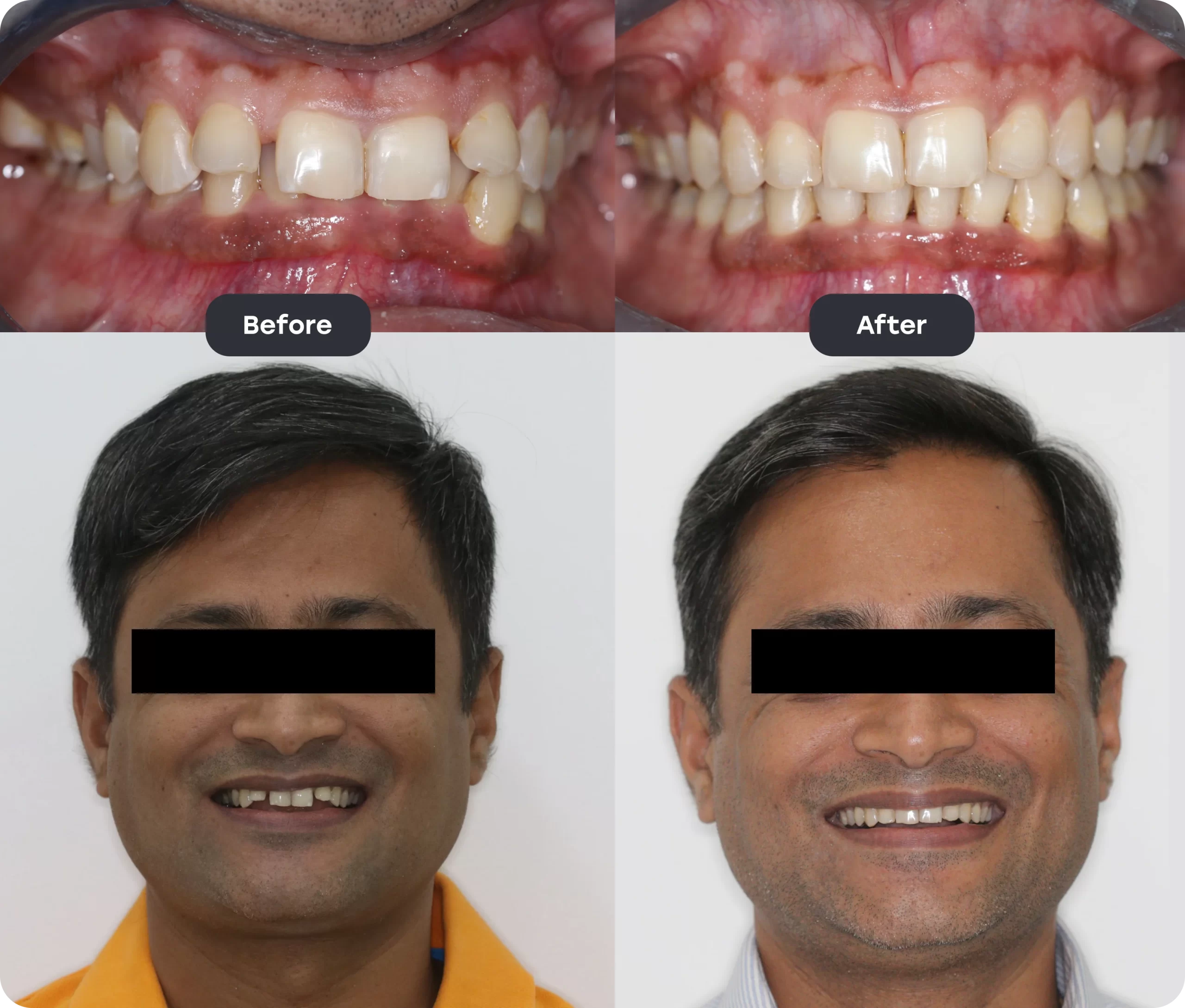 Invisalign Aligner invisalign bef aft 11 scaled