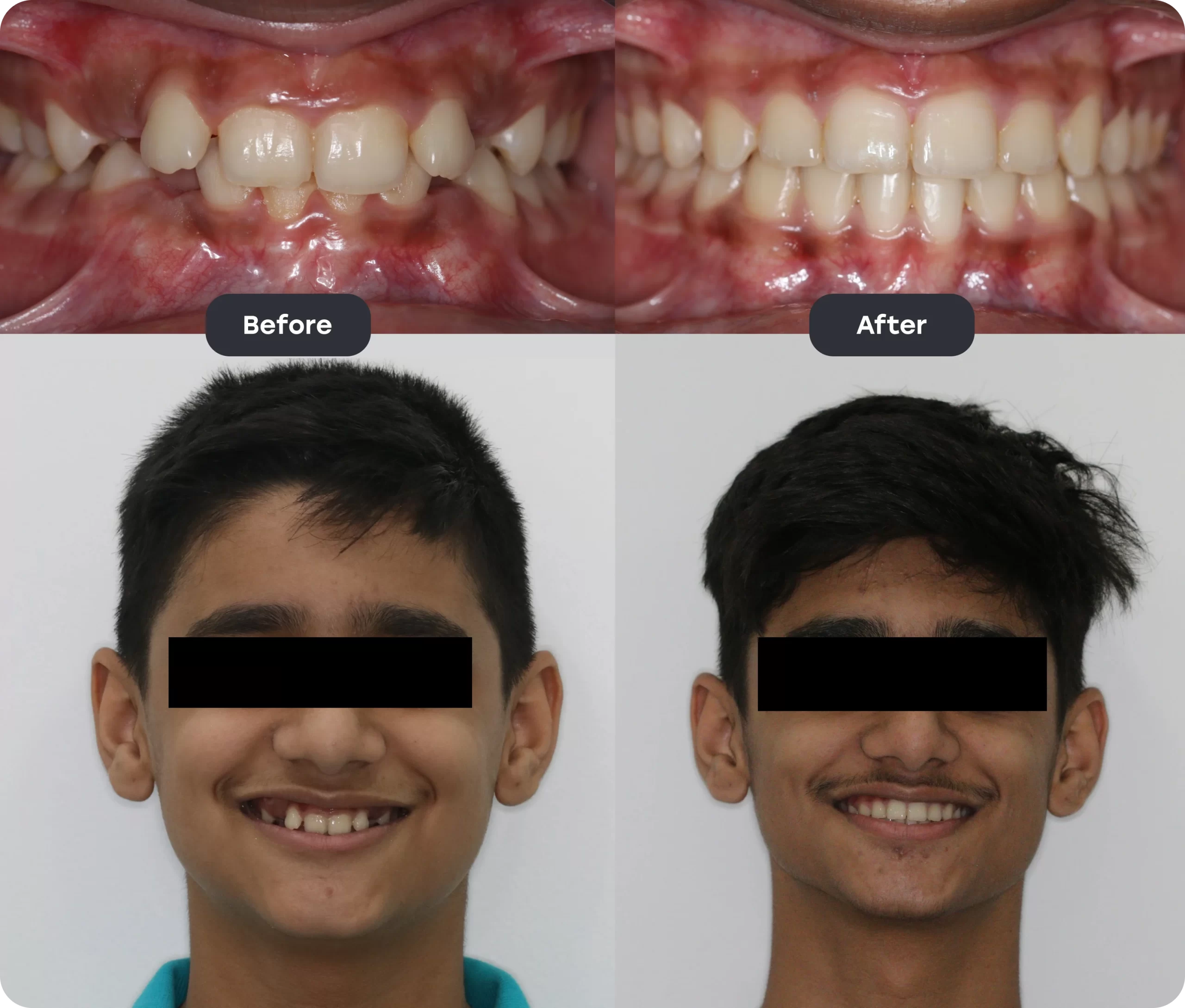 Invisalign Aligner invisalign bef aft 2 scaled