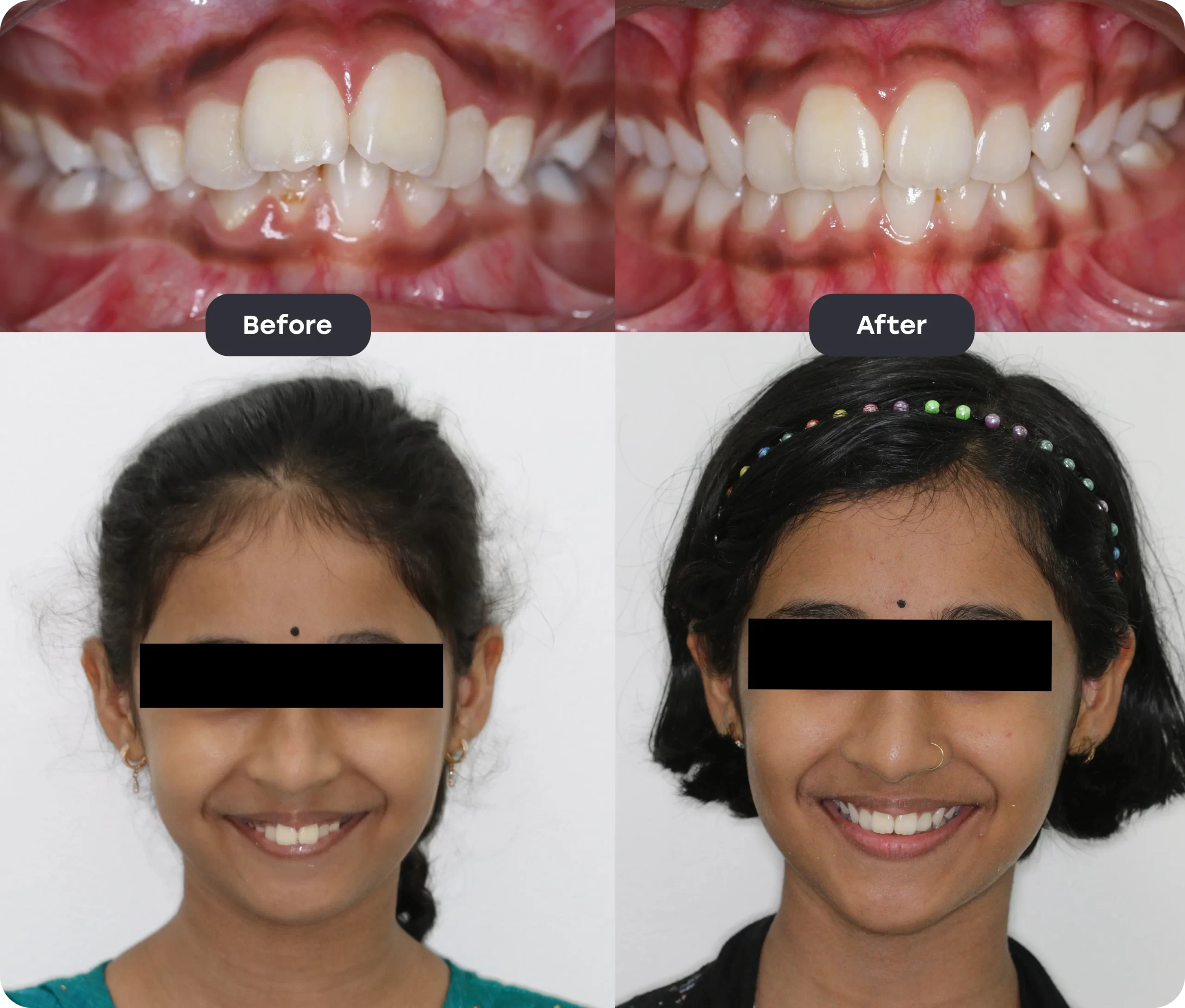 Invisalign Aligner invisalign bef aft 3 scaled
