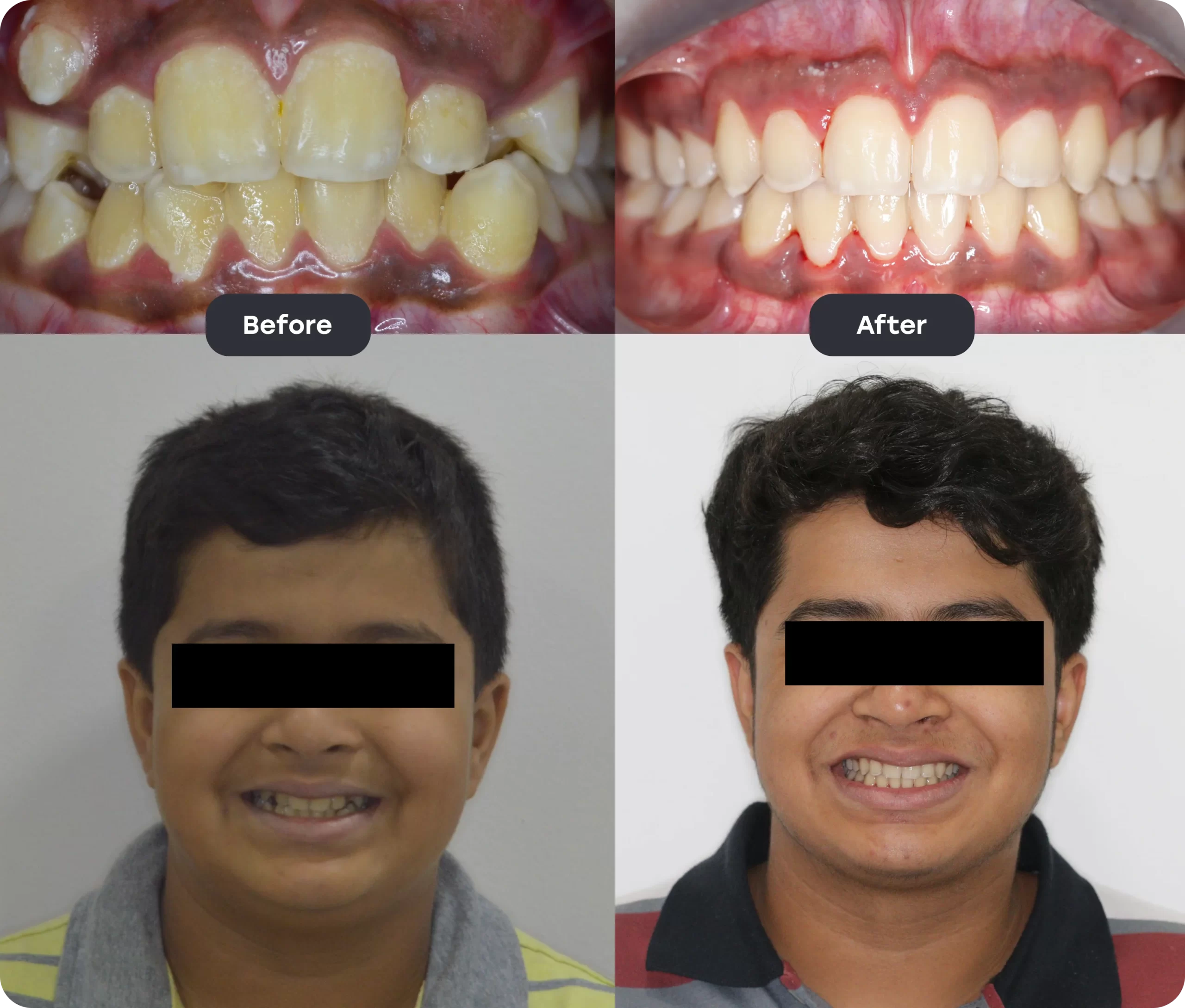 Invisalign Aligner invisalign bef aft 5 scaled