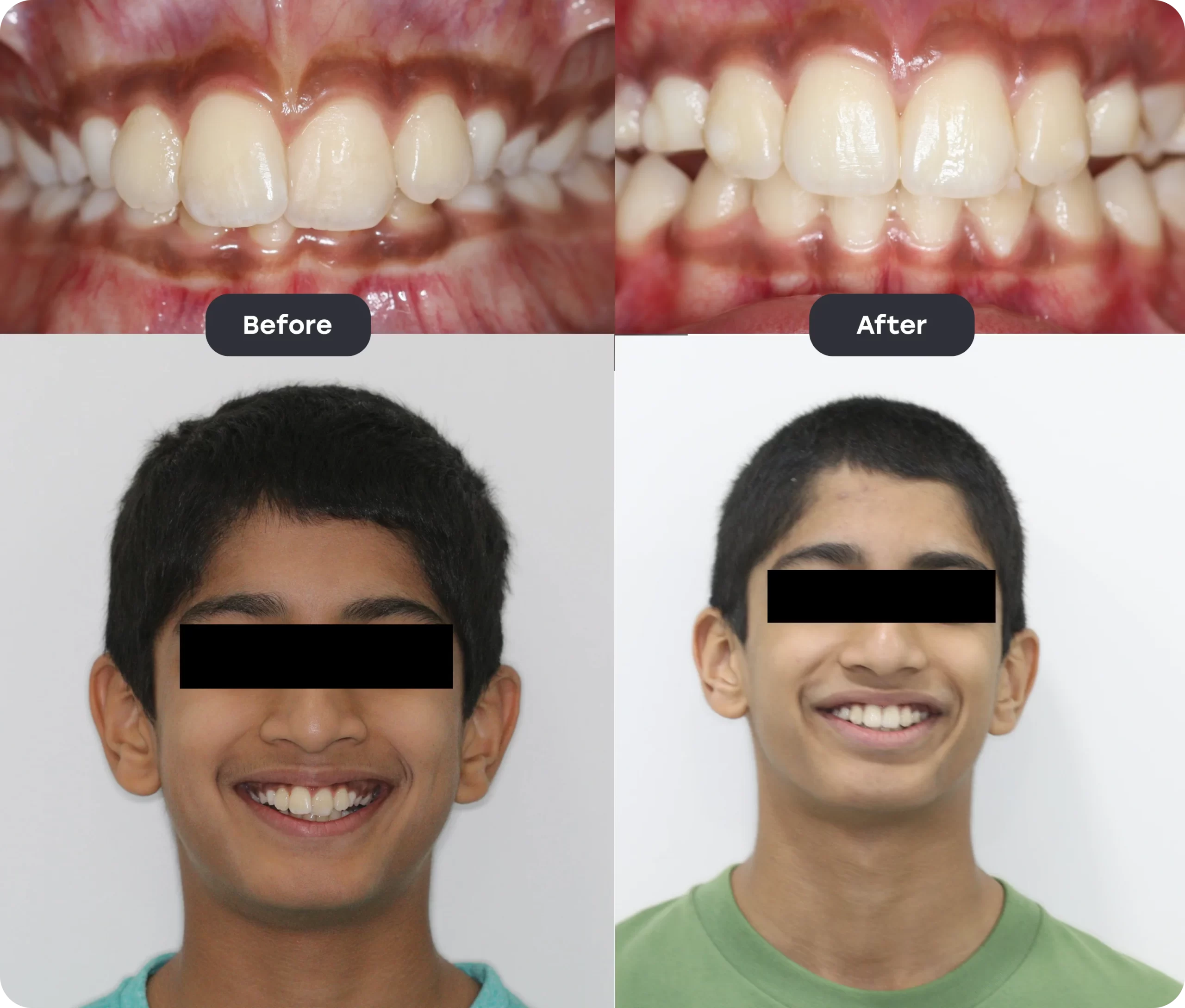 Invisalign Aligner invisalign bef aft 7 scaled