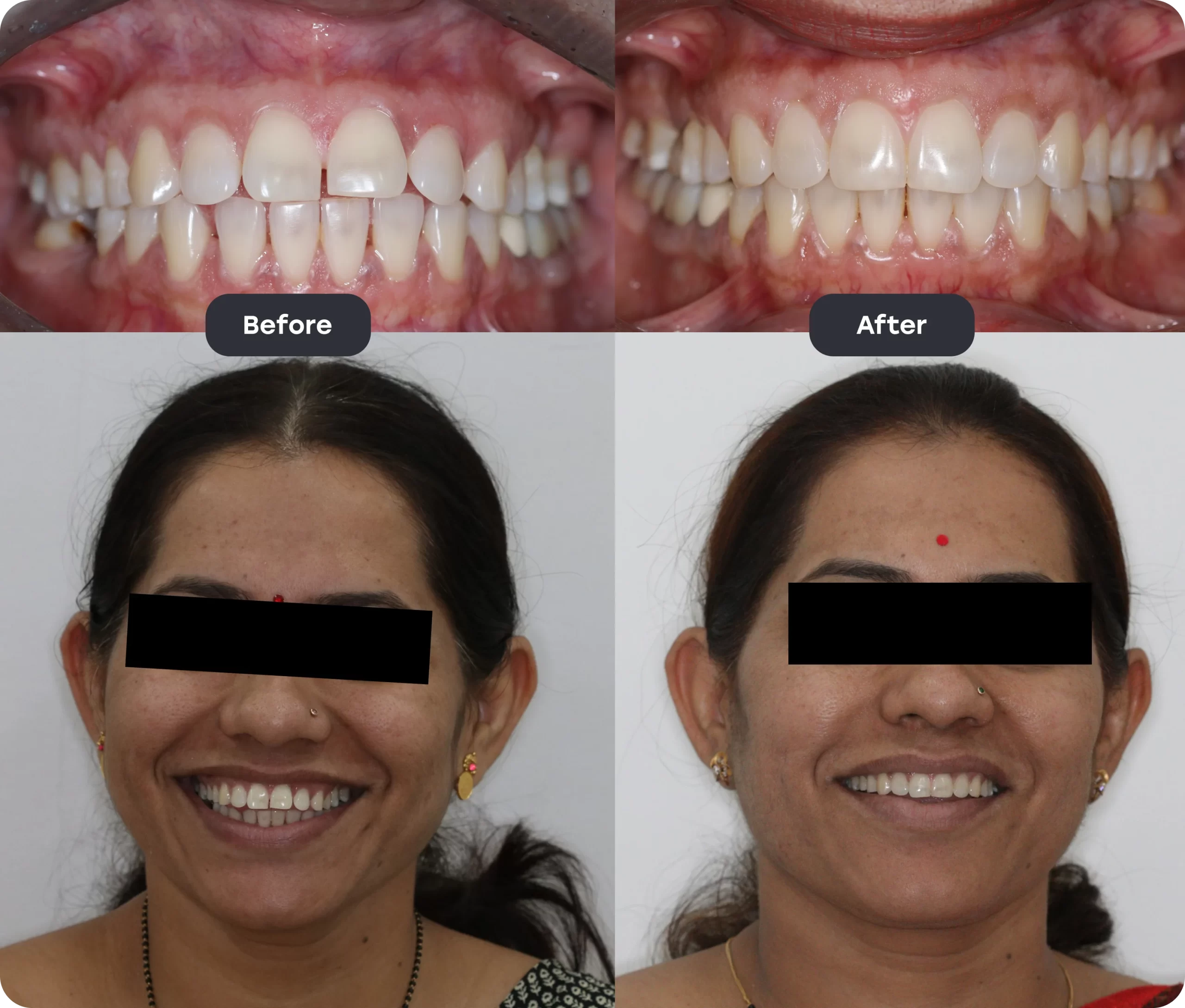Invisalign Aligner invisalign bef aft 9 scaled