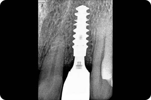 sameday implant 1