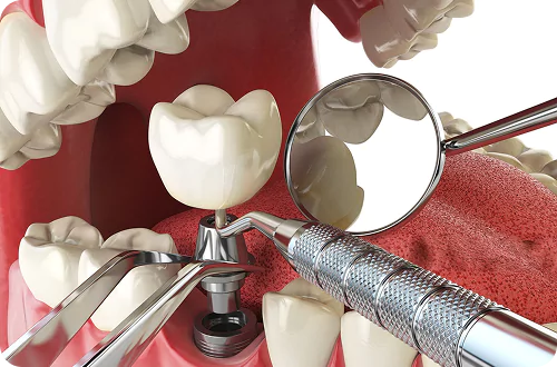 single tooth 1 1